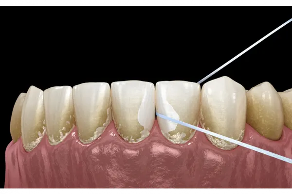 Caring for Veneers: The First 30 Days and Beyond