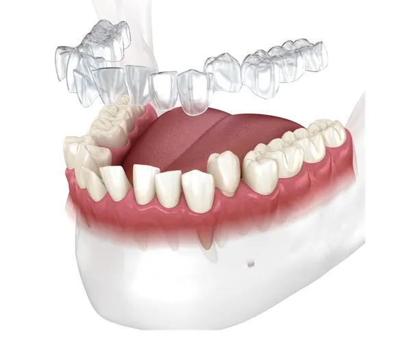 Adult Invisalign: A Realistic Timeline