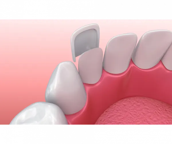 The Real Cost of Porcelain Veneers, Explained