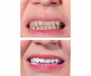 KöR Whitening, Explained